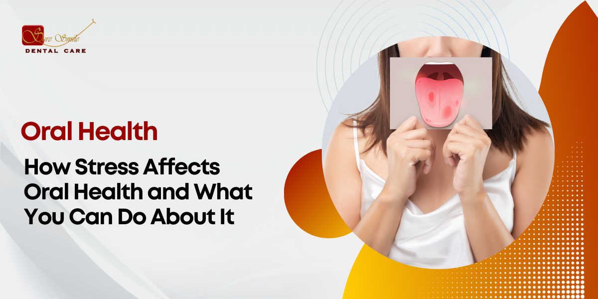 How Stress Affects Oral Health and What You Can Do About It - Sure Smile
