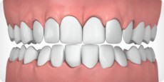 Crowded, Overlapped Teeth