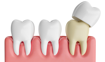Dental-Crowns