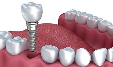 Full ceramic Zirconia crowns