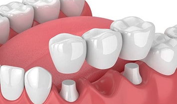 dental-implant