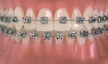 BRACES TREATMENT/ ORTHODONTICS