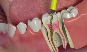 painless Root canal treatment