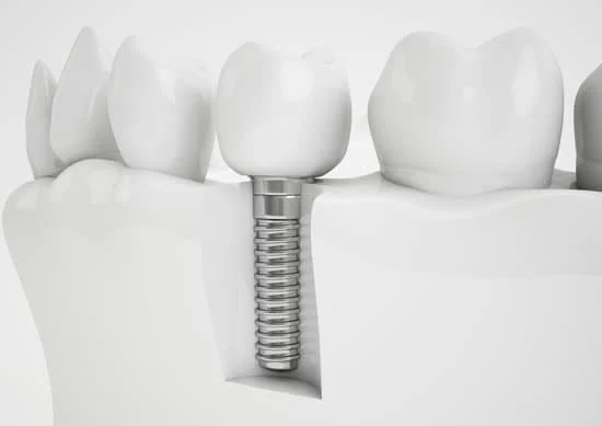 Dental Implants