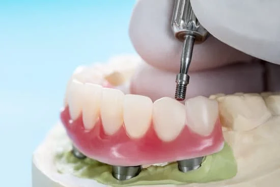 Dental Implants