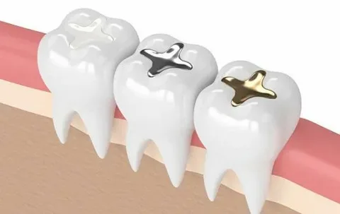 Front tooth composite filling