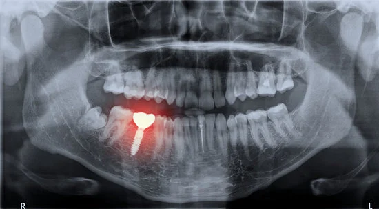 Lower Jaw Surgery