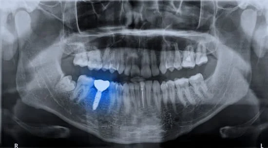 Lower Jaw Surgery
