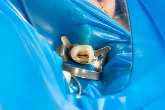 Composite Filling in Front Teeth