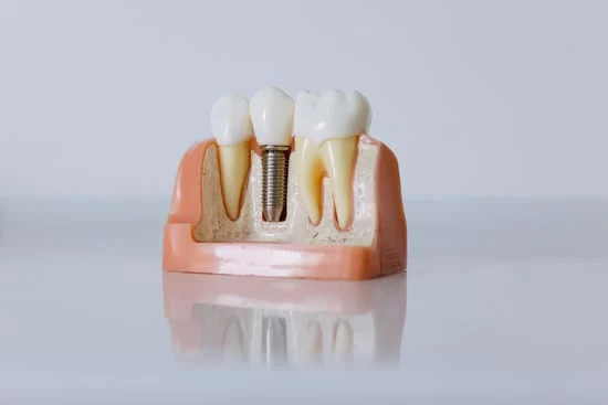 dental implant