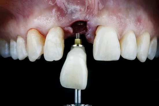 Composite Filling in Front Teeth