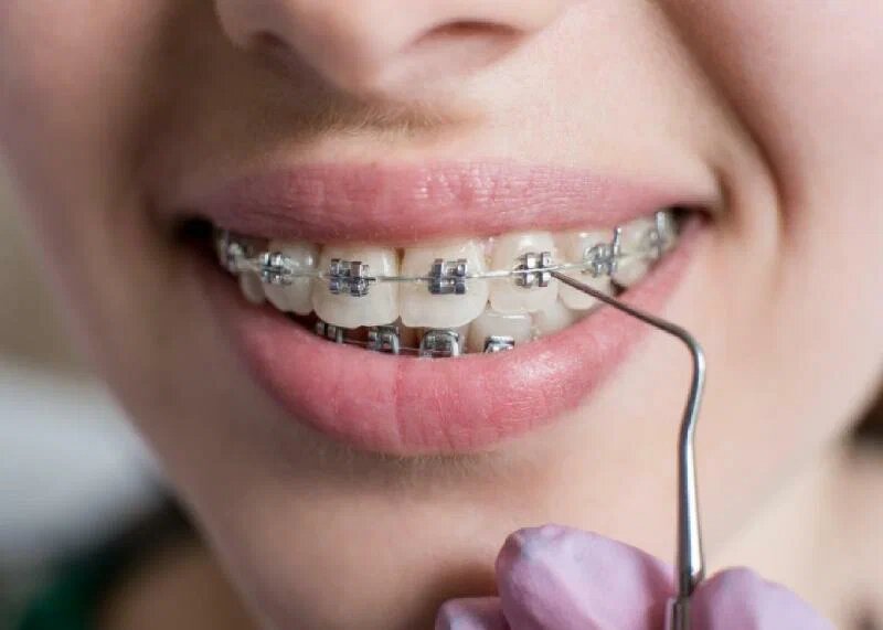 orthodontic treatments
