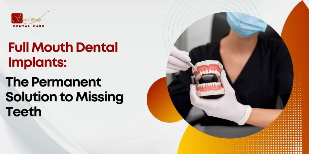 Full Mouth Dental Implants