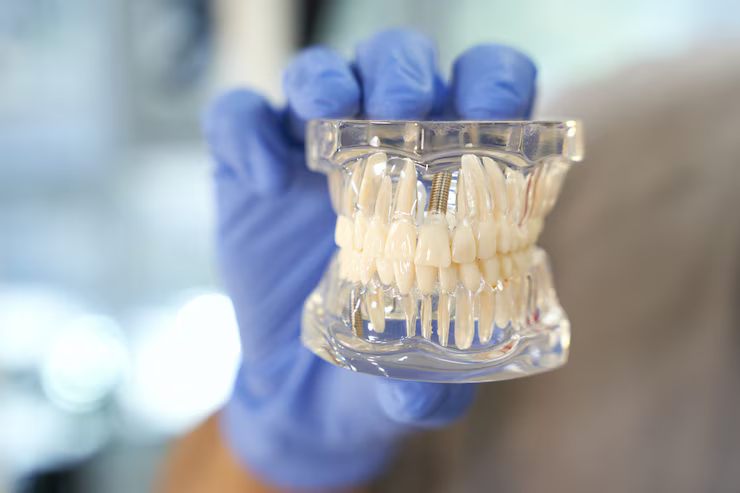 full mouth dental implants