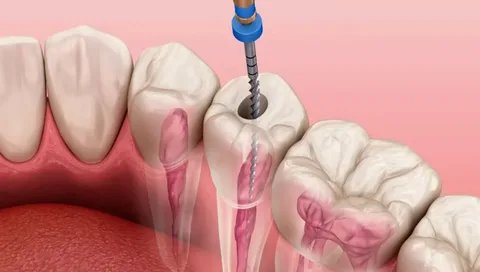 dental root canal cost