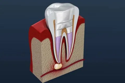 dental root canal cost