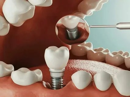 dental implants