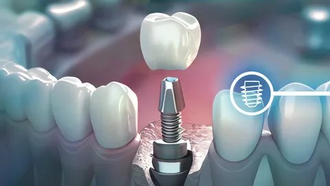 dental implants