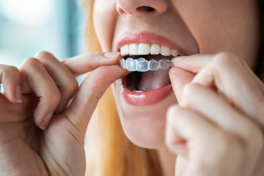 Invisalign dentist Near Me