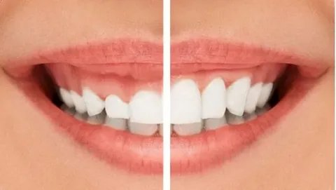 smile correction treatment