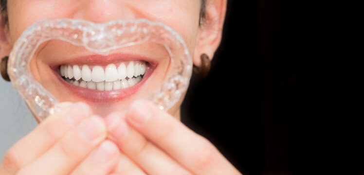 smile correction treatment