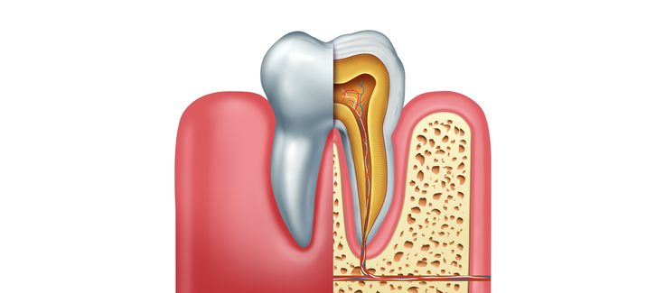 root canal treatment