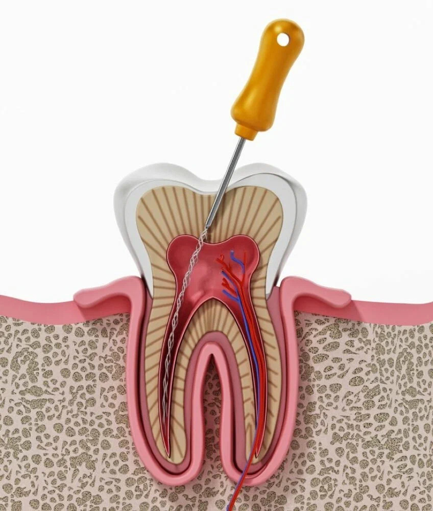 root canal treatment
