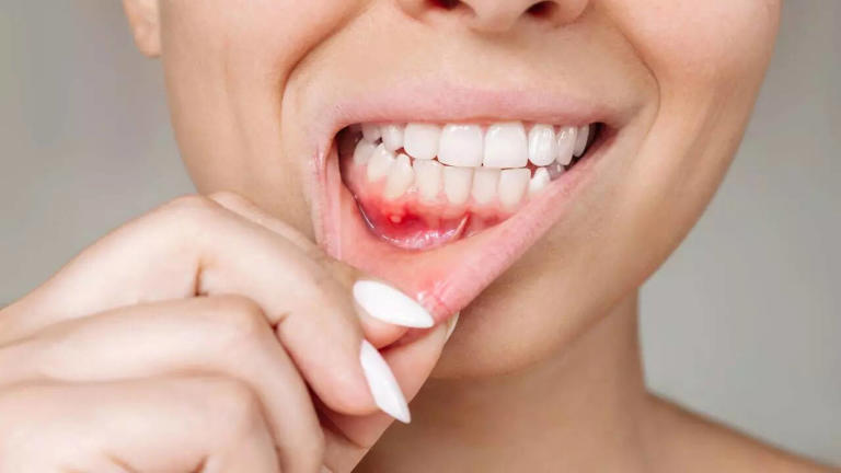 Gum disease treatment Bangalore