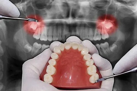 Wisdom teeth removal Bangalore