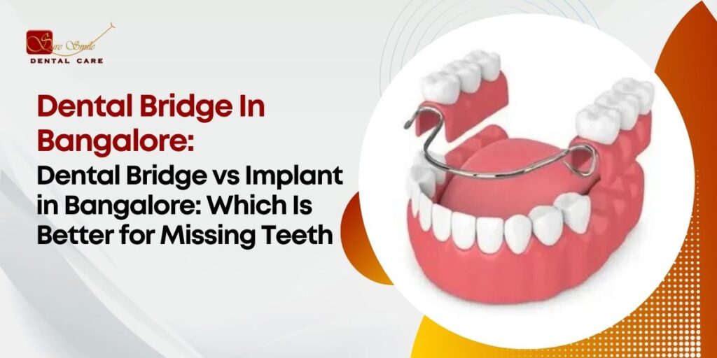 Dental Bridge In Bangalore