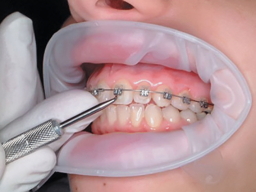 Orthodontic Treatment In Bangalore