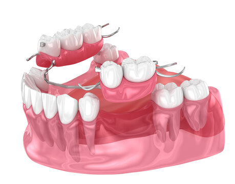 Dental Bridge In Bangalore