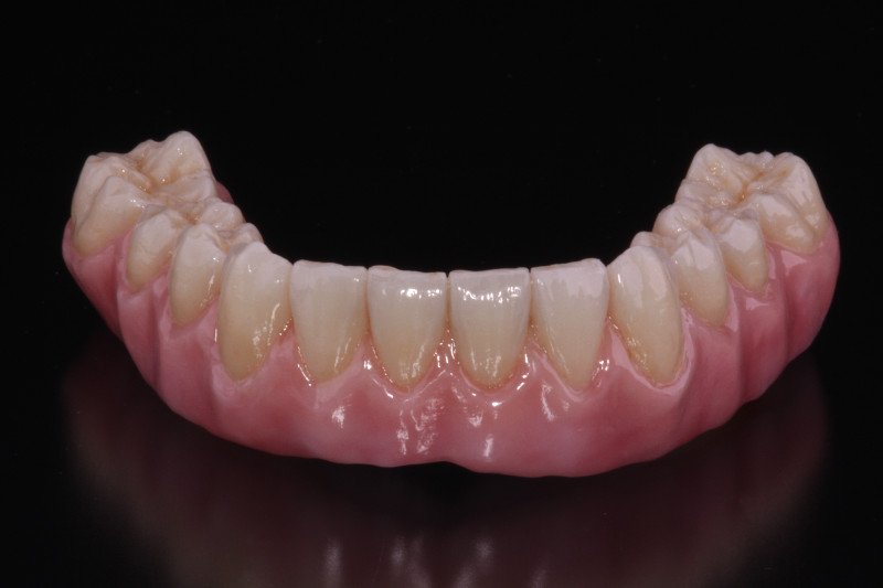 Dental Bridge In Bangalore