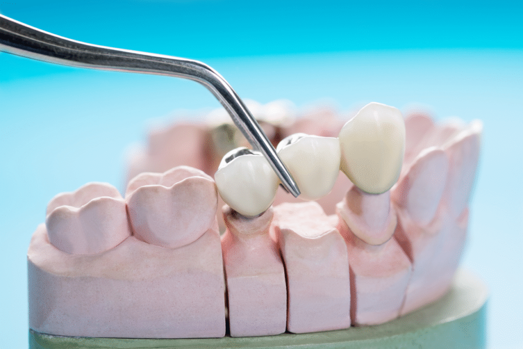 Dental Bridge In Bangalore