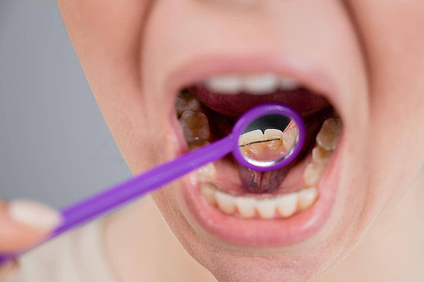 Dental Bite Correction