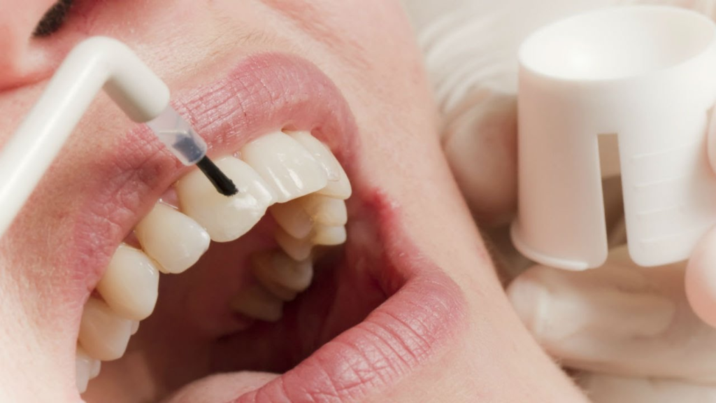 fluoride in dental care