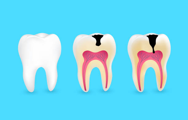 stages of tooth decay
