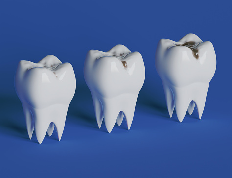 stages of tooth decay