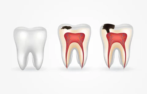 stages of tooth decay