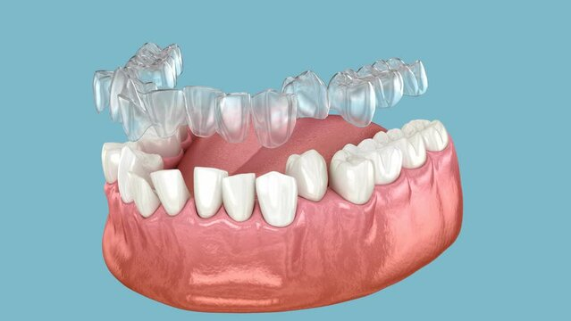 Dental Bite Correction