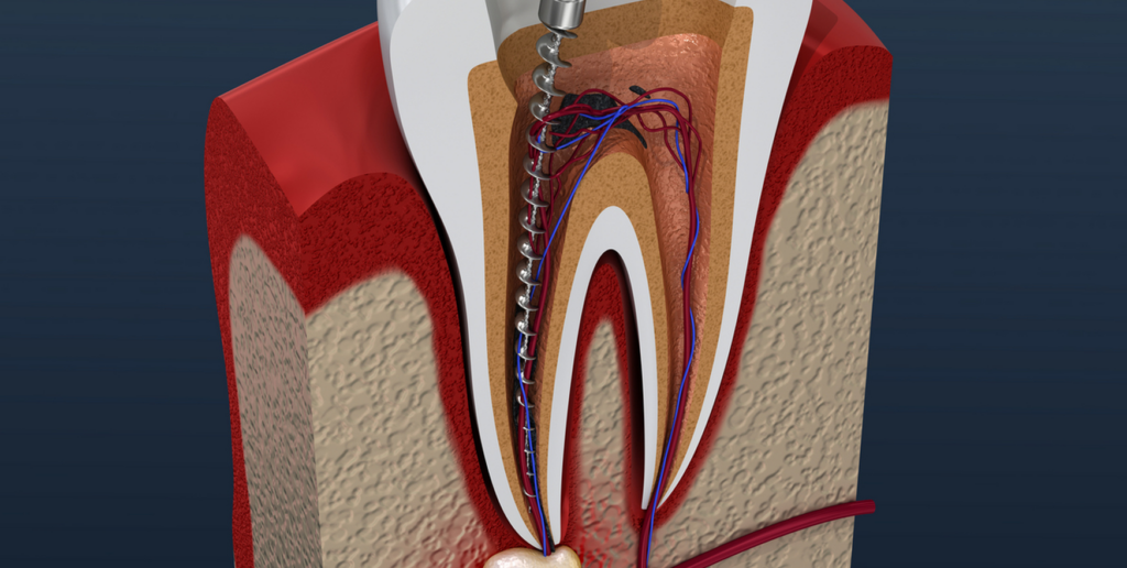 Root Canal Treatment Cost Near Me