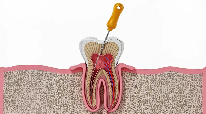 root canal treatment cost near me