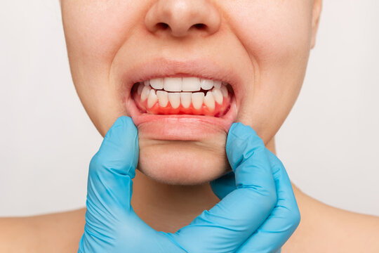 Gum Disease Treatment