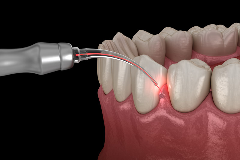Gum Disease Treatment