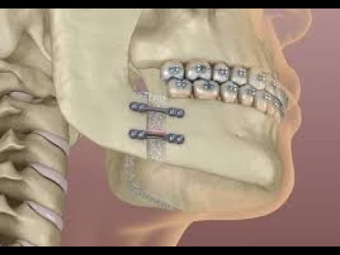 laser gum removal