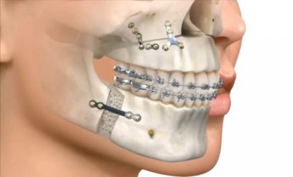 jaw realignment surgery for overbite