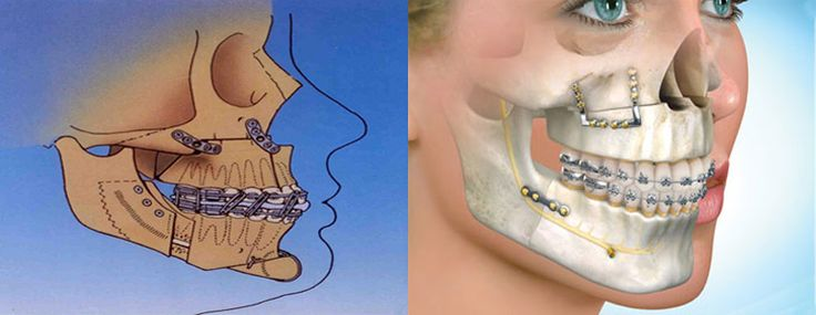 jaw realignment surgery for overbite