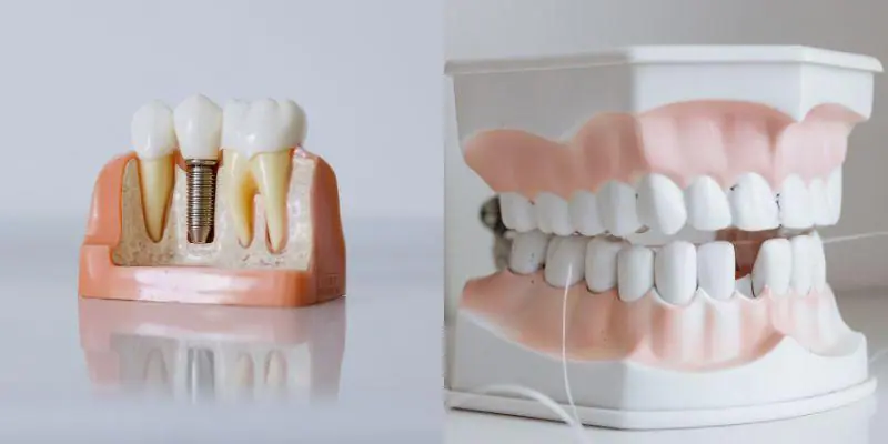 Dental Implants vs Dentures