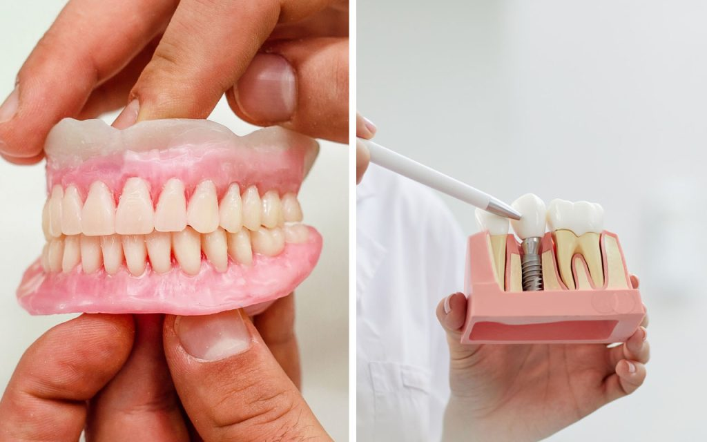 Dental Implants vs Dentures