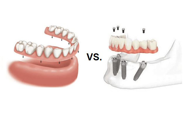 Dental Implants vs Dentures